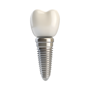 Implante Dental Yalodent ProFix™